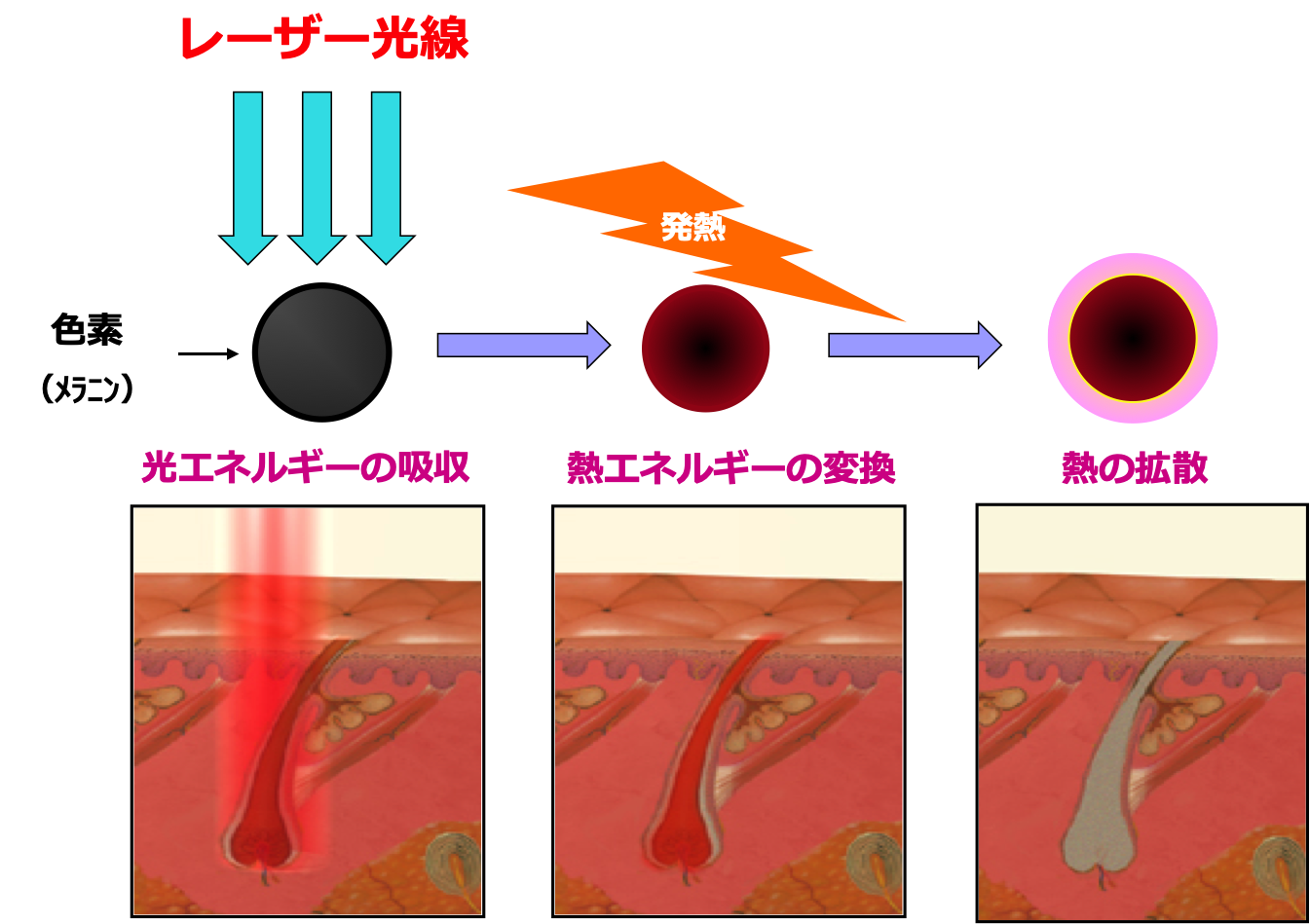 医療レーザー脱毛の仕組み